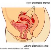 /album/hablando-de-endometriosis/images-3-jpg/